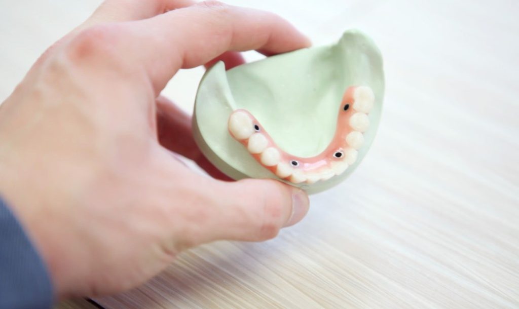 Dental Implants from as Low as £440 per Tooth