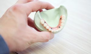 Dental Implants from as Low as £440 per Tooth