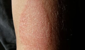 The most effective home remedies to cure eczema