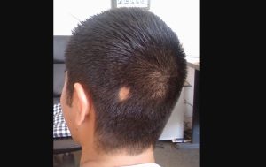 Alopecia Areata: Spot Baldness caused by hair follicles