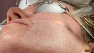 Laser Skin Tightening