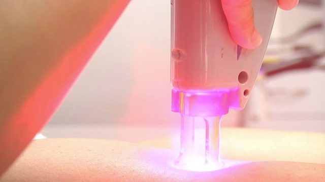 Laser Hair Removal