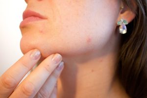 How to Choose the Right Acne Treatment for Your Skin Type