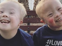 twins with down syndrome