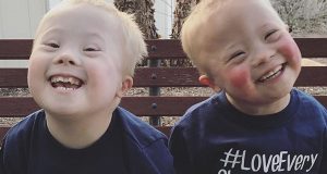 twins with down syndrome