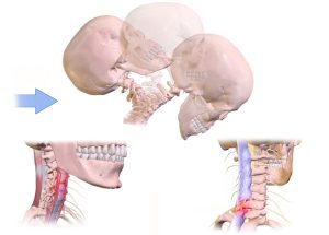 What’s the Best Treatment for Whiplash?