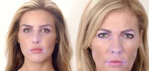 REASONS WHY COOLSCULPTING IS ON THE RISE