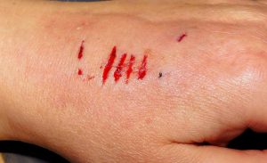 What’s the Average Personal Injury Settlement?