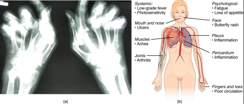 Know What Is Autoimmune Arthritis On This World Autoimmune Arthritis Day