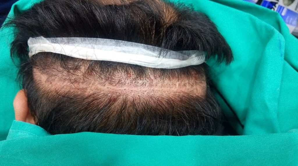 Frequently Asked Questions About Scalp Micropigmentation