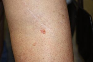 Melanoma Skin Cancer 101: What Are the Different Melanoma Types?