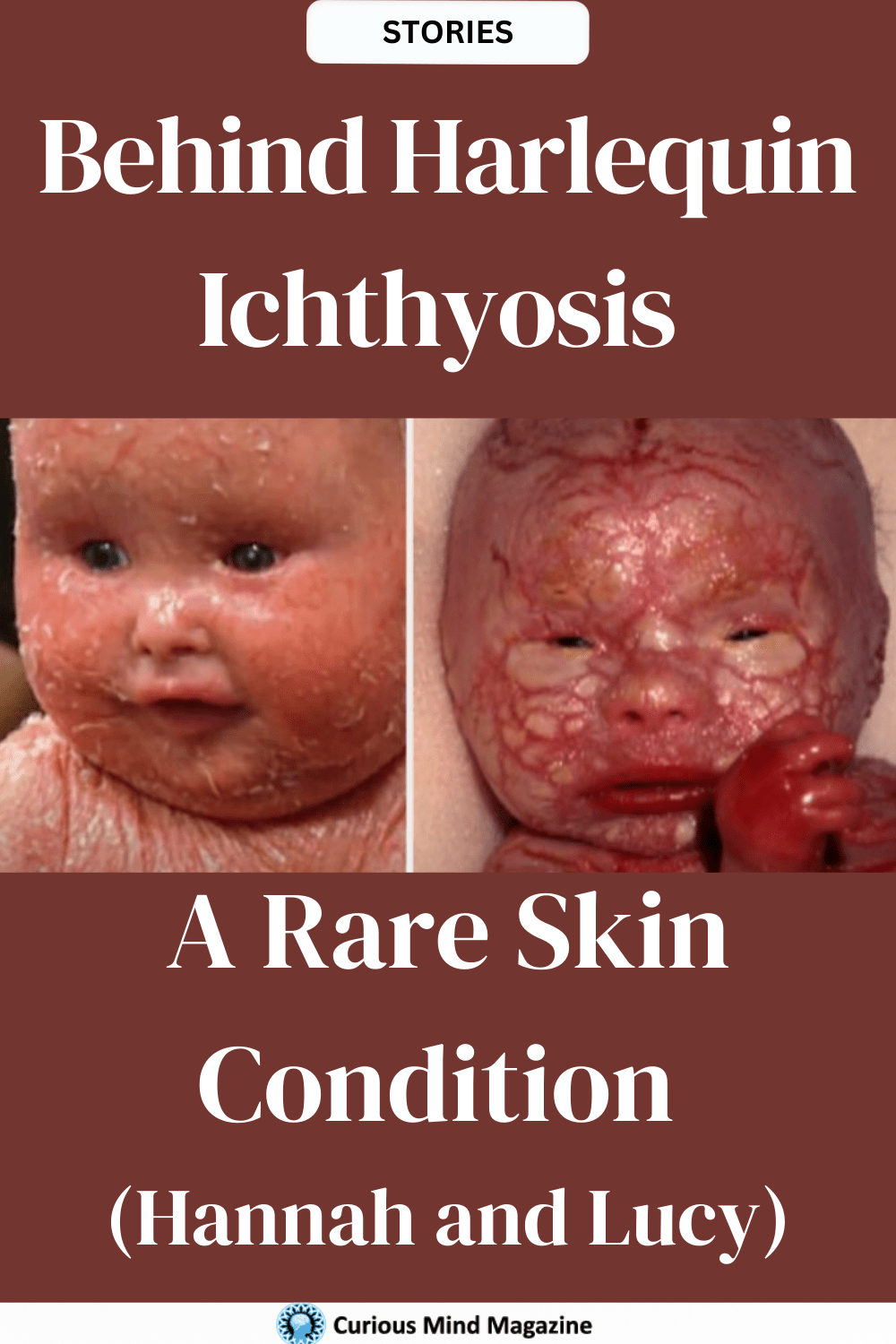 Behind Harlequin Ichthyosis - A Rare Skin Condition (Hannah and Lucy)