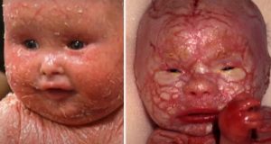 harlequin ichthyosis hannah and lucy