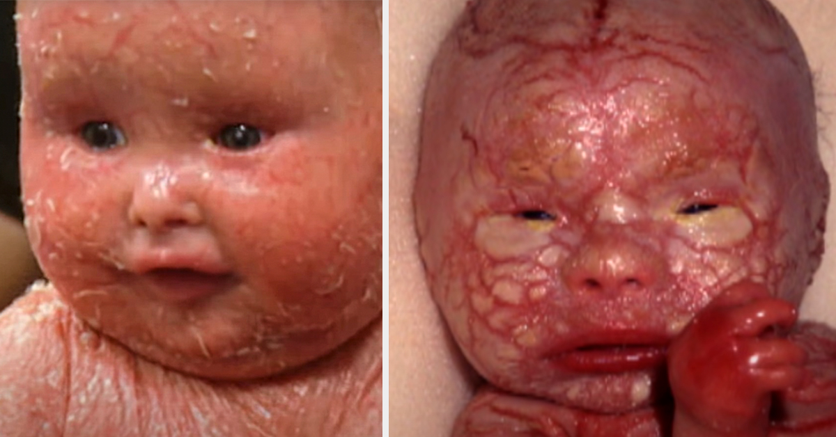harlequin ichthyosis hannah and lucy