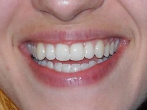 Why Taking Care of Your Gums Is Important