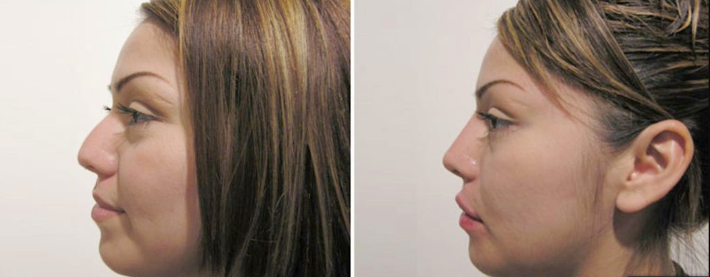 How to get an affordable nose job?