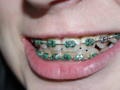 A Brief History of Braces