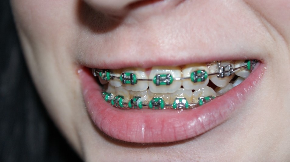 A Brief History of Braces