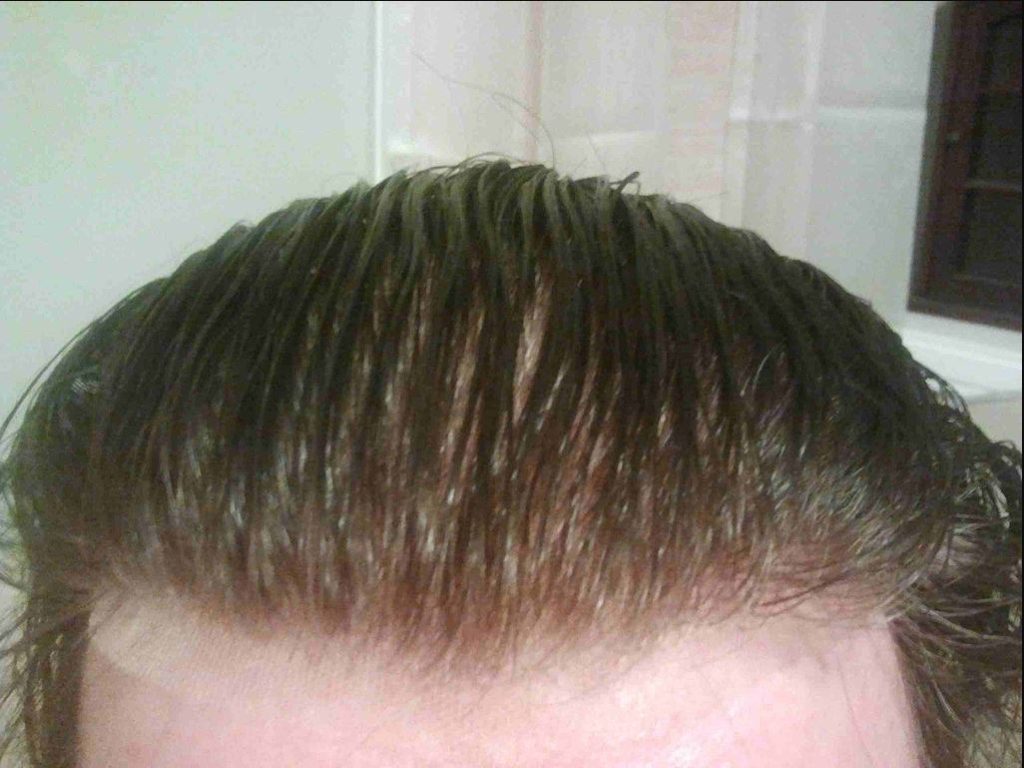 How Laser Therapy Can Regrow Hair