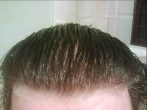 How Laser Therapy Can Regrow Hair