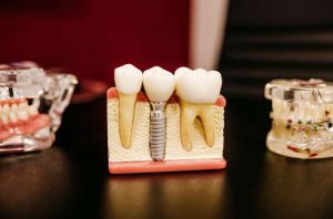 What to Look for When Searching for an Implant Dentist?