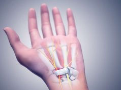 Carpal Tunnel Syndrome 