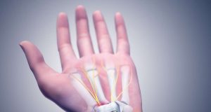 Carpal Tunnel Syndrome 