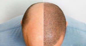 Scalp Micropigmentation