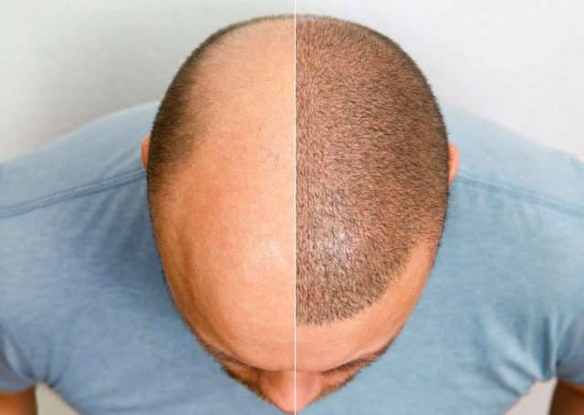 Scalp Micropigmentation