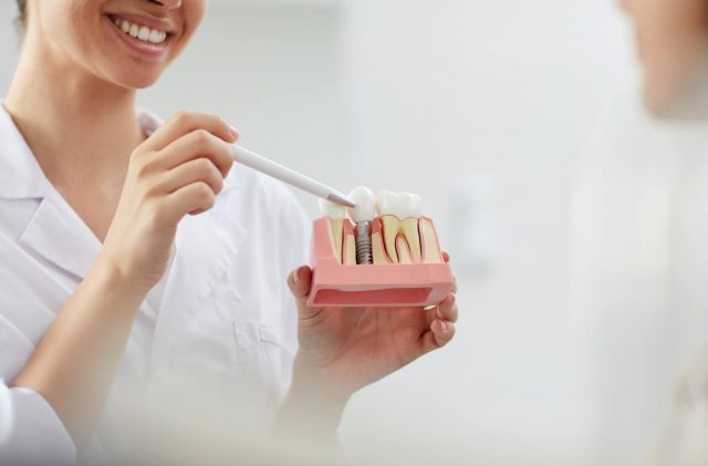 Dental Implants