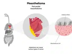 What Makes Mesothelioma So Deadly