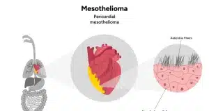 What Makes Mesothelioma So Deadly