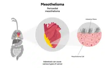 What Makes Mesothelioma So Deadly