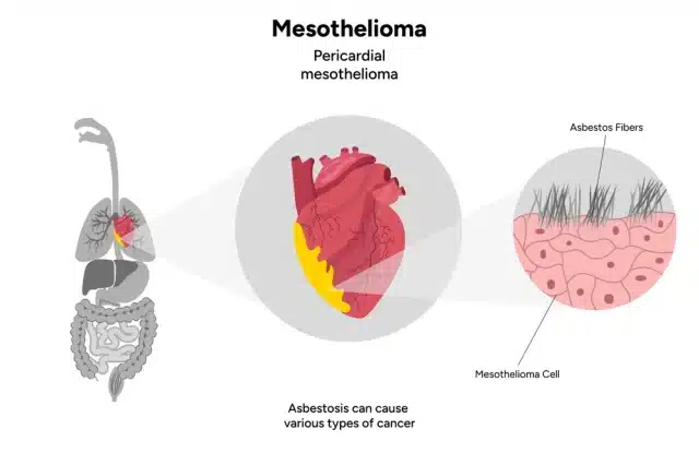 What Makes Mesothelioma So Deadly