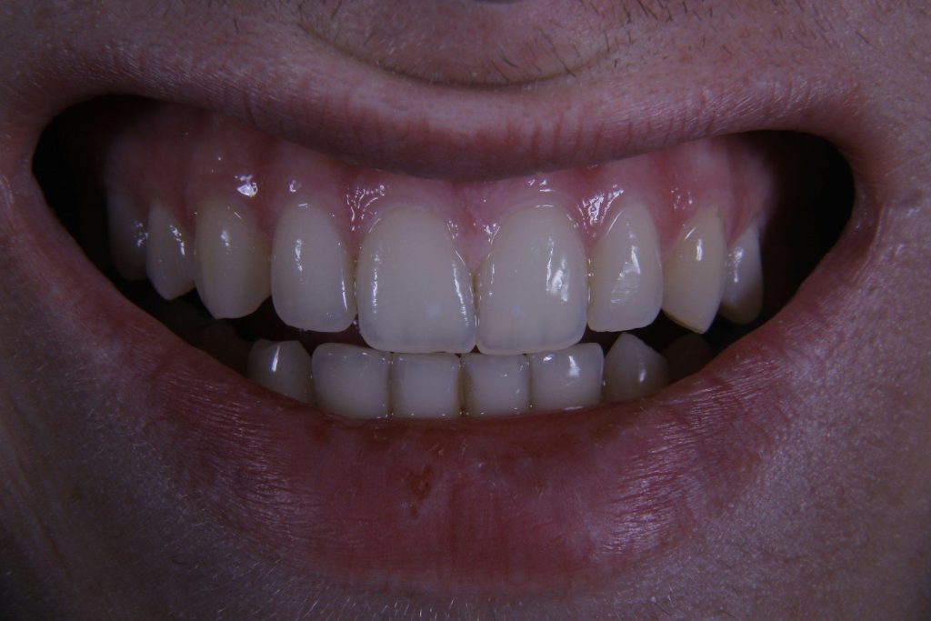 White Spots on Teeth: Causes, Treatment, and Prevention