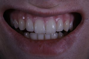 White Spots on Teeth: Causes, Treatment, and Prevention