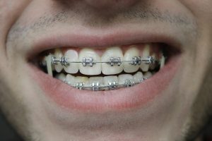 Silver Teeth for Kids: Why Dentists Use Them and Are They Safe