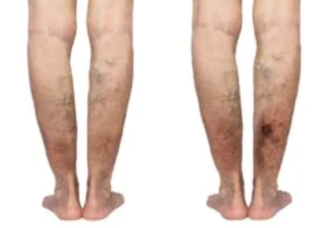 Top 6 Vein Treatment Options Ranked by Recovery and Effectiveness